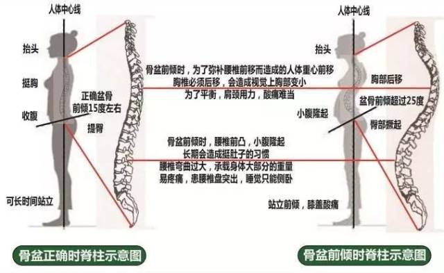 骨盆前倾是骨盆向前病态地偏移,造成腰椎不正常的生理前凸,较正确的