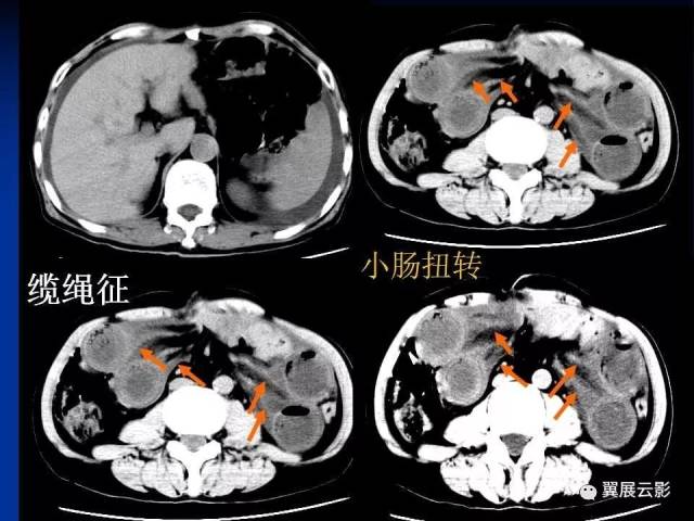 急性绞窄性肠梗阻ct诊断