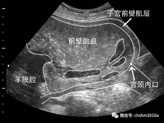 前置胎盘超声新标准