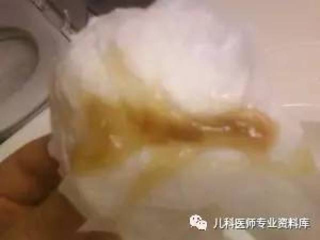 儿童鼻涕的秘密