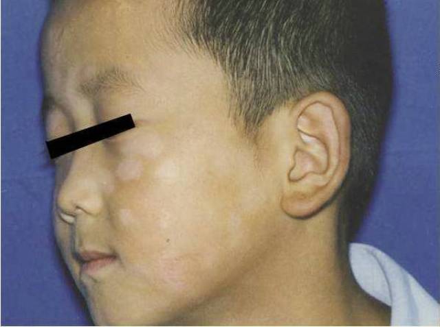 很多种皮肤病都可以引起脸部白斑,比如白色糠疹(也叫做单纯糠疹),花斑