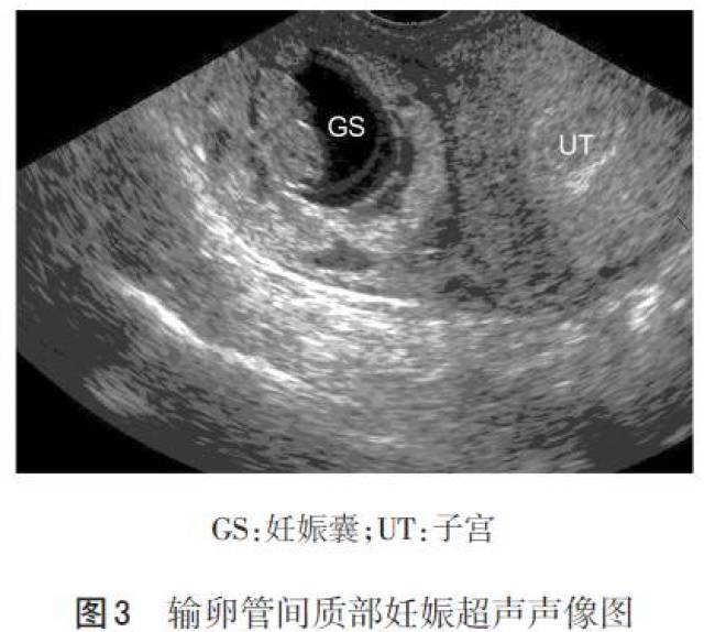 少见异位妊娠超声特征及诊断