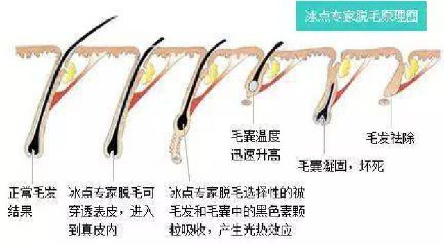 冰点脱毛优势
