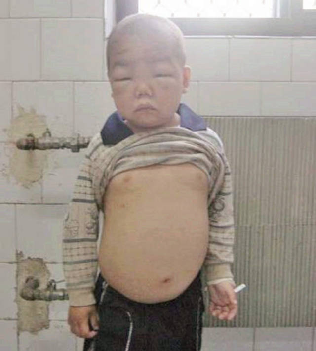 孩子给奶奶突然带成了一大胖子,医生的话让儿子一气之