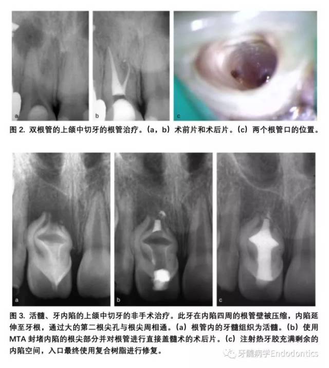 上颌尖牙