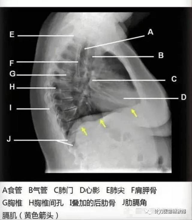 侧位胸片时所透过的组织比                    胸部正常组织的矢状