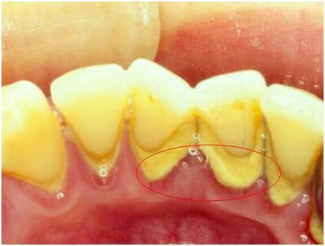 牙结石又称牙石,通常存在于唾液腺开口处的牙齿表面.