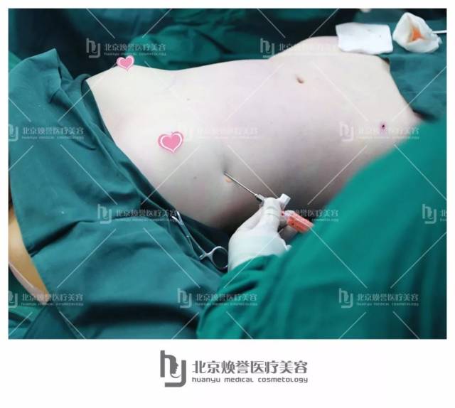 【焕誉案例】外国妹子也爱上了自体脂肪丰胸,完美只差