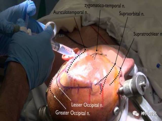 头皮表浅神经阻滞麻醉,包括眶上,滑车上,耳颞,颧颞,枕大和枕小神经.