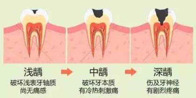 蛀牙更加通俗的描述就是在牙齿上出现了小洞,大洞,甚至大面积的牙体