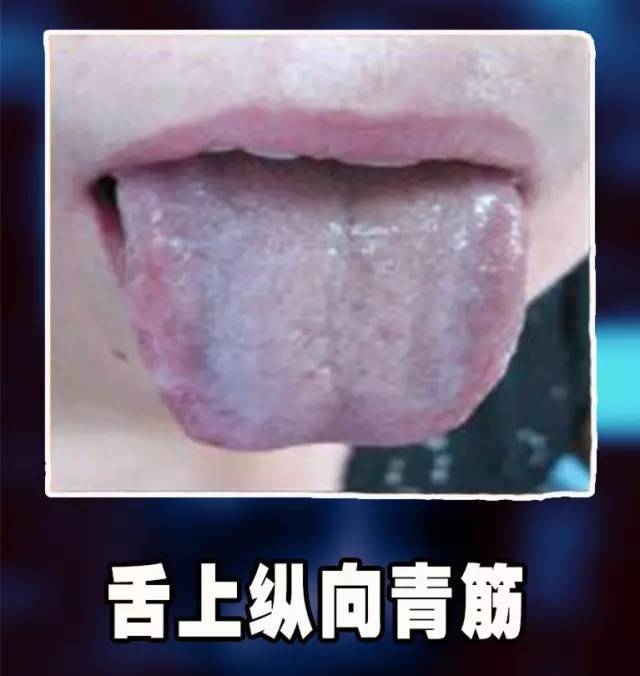 红细胞增多症: 长期肝硬化或慢性肝病的患者,无其他原因出现红细胞