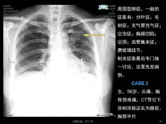 读片秘籍:肺癌,肺炎,肺结核的鉴别