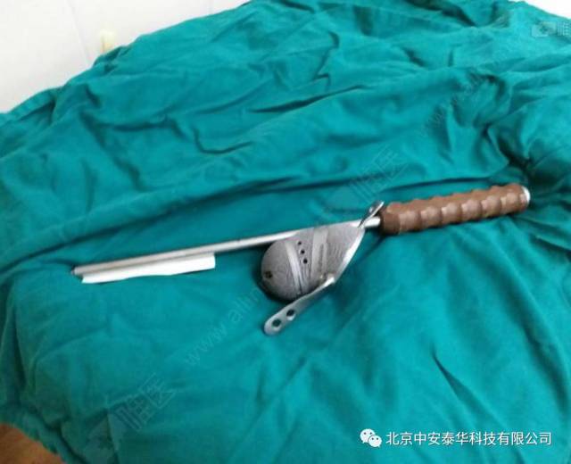 北京中安泰华3d打印个性化定制技术助力复杂髋关节翻修手术