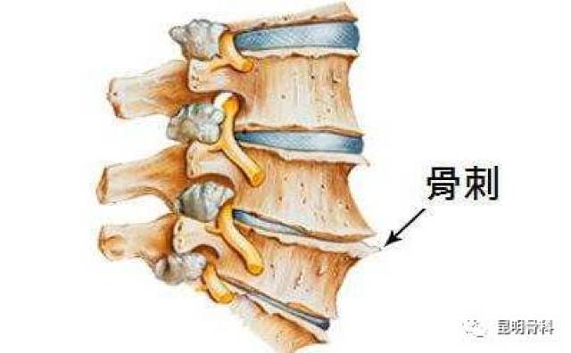 一文读懂:骨质增生