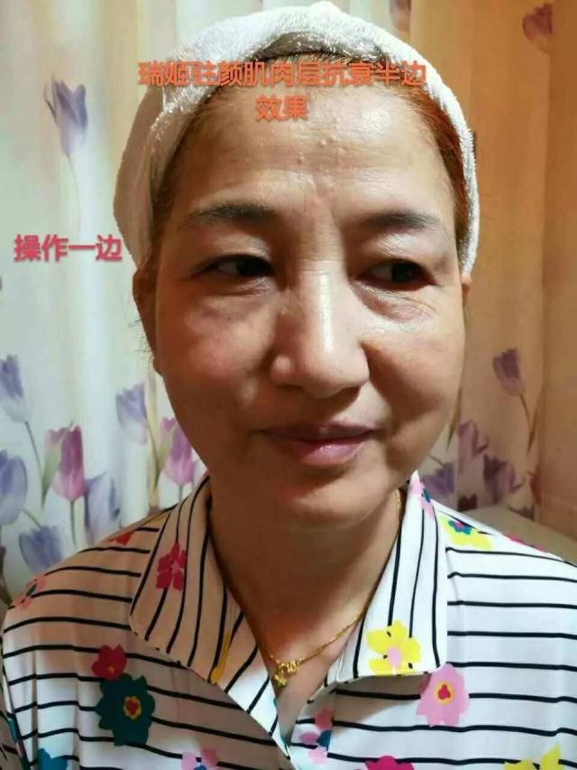 鸡爪纹)一次操作15分钟三天起效,20天皱纹淡化90%以上,双颊赘肉明显
