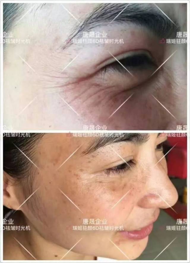 鸡爪纹)一次操作15分钟三天起效,20天皱纹淡化90%以上,双颊赘肉明显