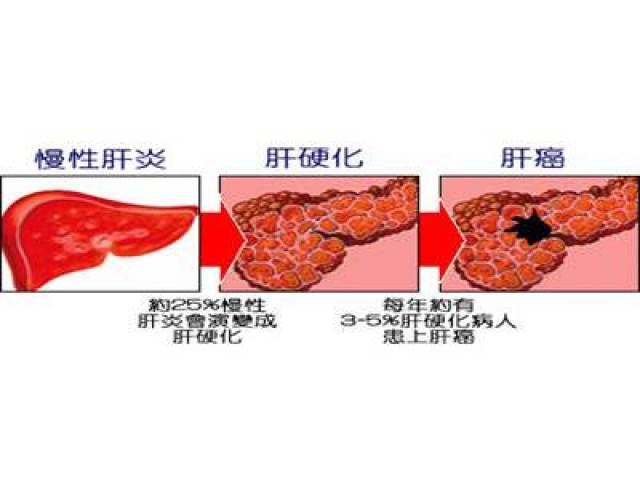 终于找到一个对付肝硬化的好办法