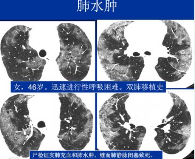 最可能的诊断:病毒性肺炎,卡氏肺孢子虫肺炎,肺出血,肺水肿,过敏性