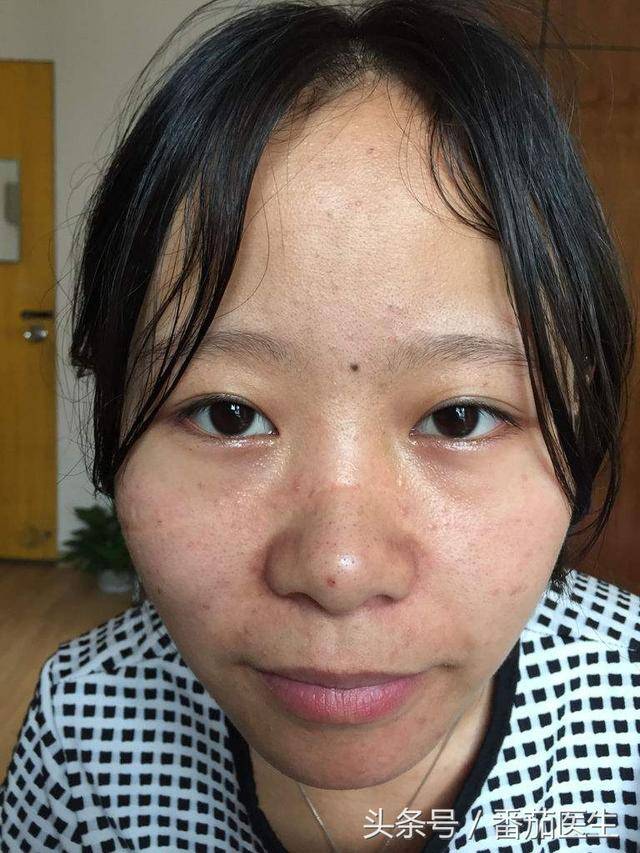 肝病——自测十九种症状