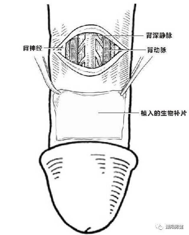 热烈祝贺adm脱细胞生物补片技术落户溧阳◇◇你与"强者"只有一块0.