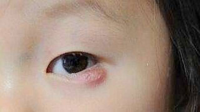 孩子眼睛长"挑针"怎么办? 治疗需宜早,预防更重要!