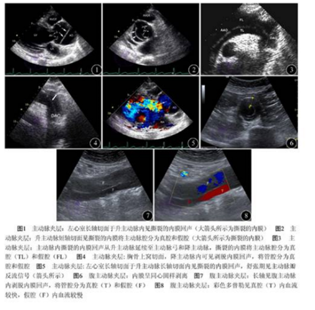 主动脉夹层的无线超声诊断