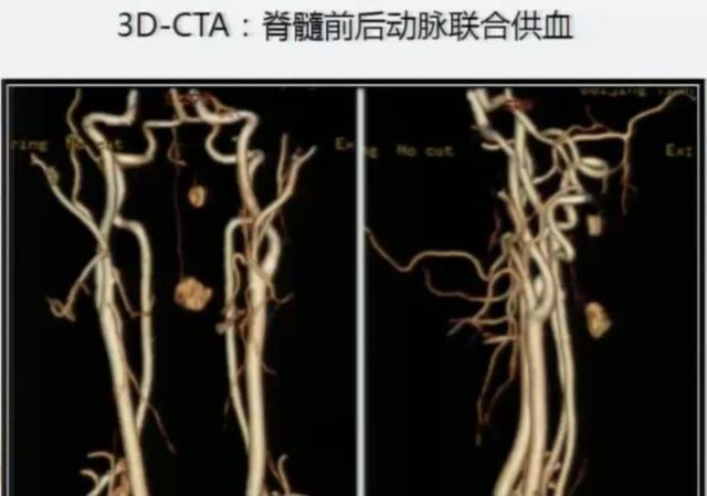 [演讲]天坛医院徐宇伦: 脊髓外科为什么都要用侧卧位 脊髓血管网织