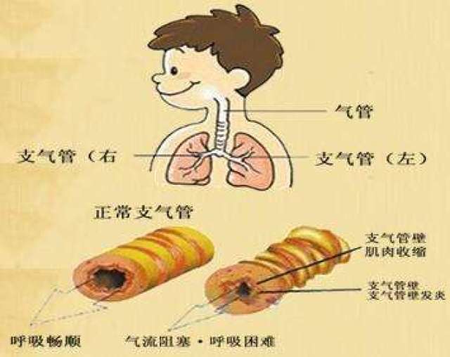 小儿性支气管炎发病原因?