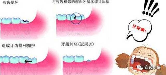 牙疼不是病 疼起来要人命 红瑞小贴士告诉你智齿到底能不能拔?