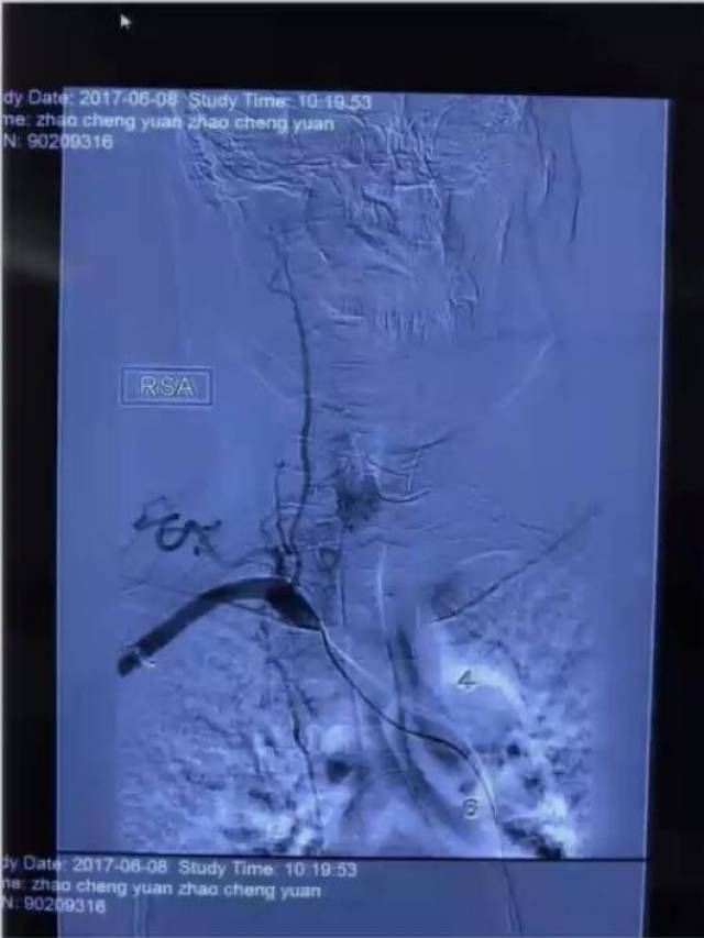 演讲天坛医院徐宇伦脊髓外科为什么都要用侧卧位脊髓血管网织细胞瘤有