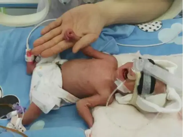 延安市人民医院新生儿科成功为仅2斤重