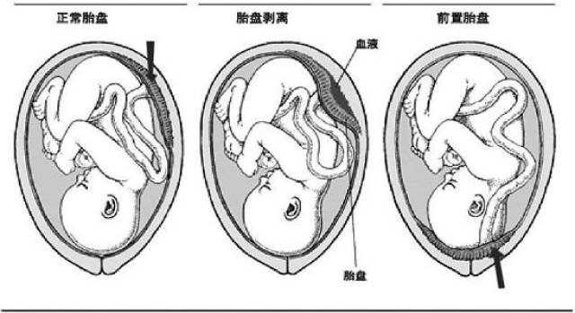 孕早期流血怀男孩 "十男九漏"靠谱吗?