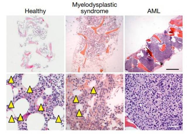 相比与正常人骨髓(左)中大量存在的脂肪细胞(箭头)aml患者的骨髓几乎
