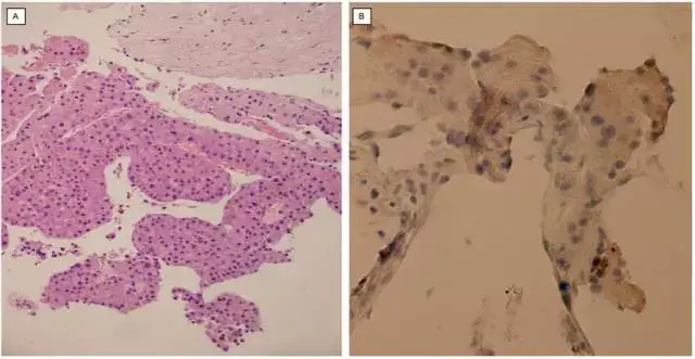 肝细胞癌的h&E染色病理学特征(a)和pd_l1免疫染色(b)(阴性)