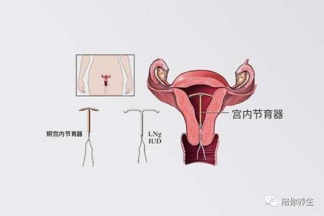 女人上环容易取环难 你知道取环到底有多疼吗