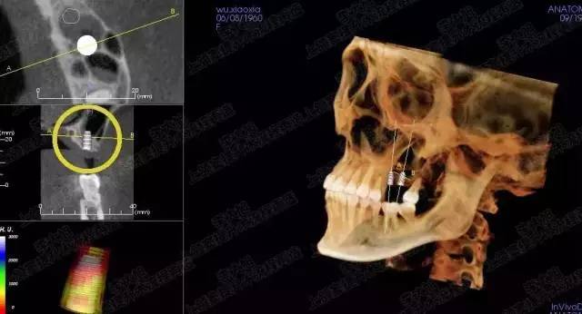 【精品课程】解决90%以上上颌窦提升病例,安全内提10mm