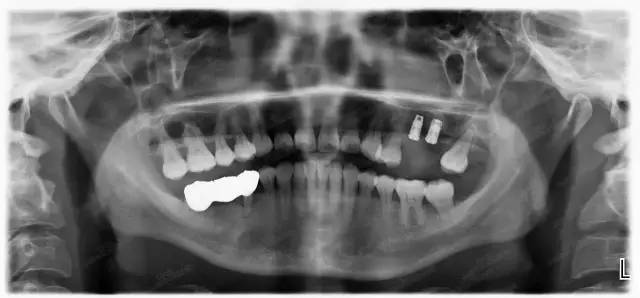 【精品课程】解决90%以上上颌窦提升病例,安全内提10mm