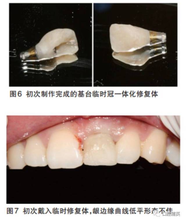 植入后牙槽窝与植体间间隙小于1mm.安放愈合基台.
