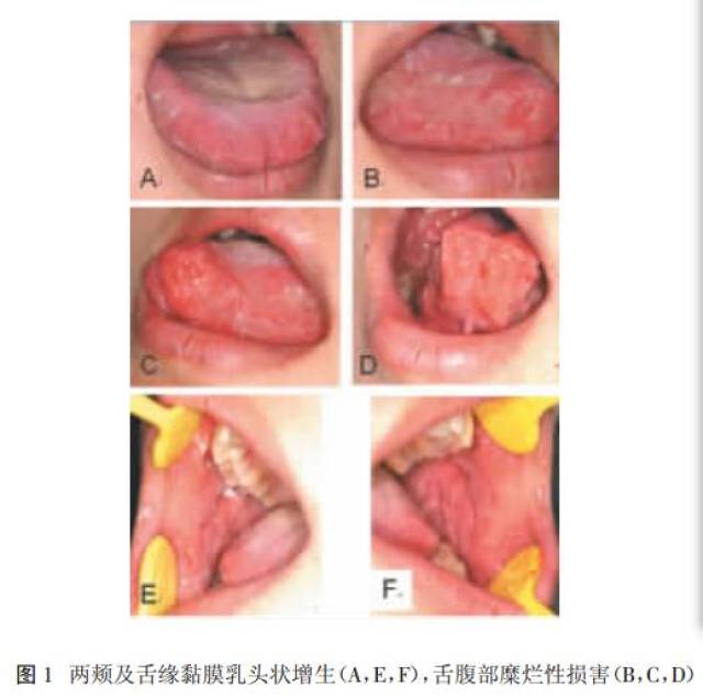 口腔增殖型天疱疮1例