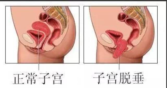 嘉兴一阿姨走着走着子宫和膀胱竟然都脱了出来……这5种情况下最危险,赶紧看看你有吗?