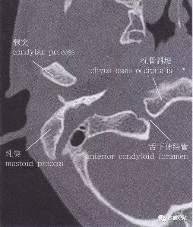 【解剖】颞骨大体解剖 轴位及冠状位ct断层图像