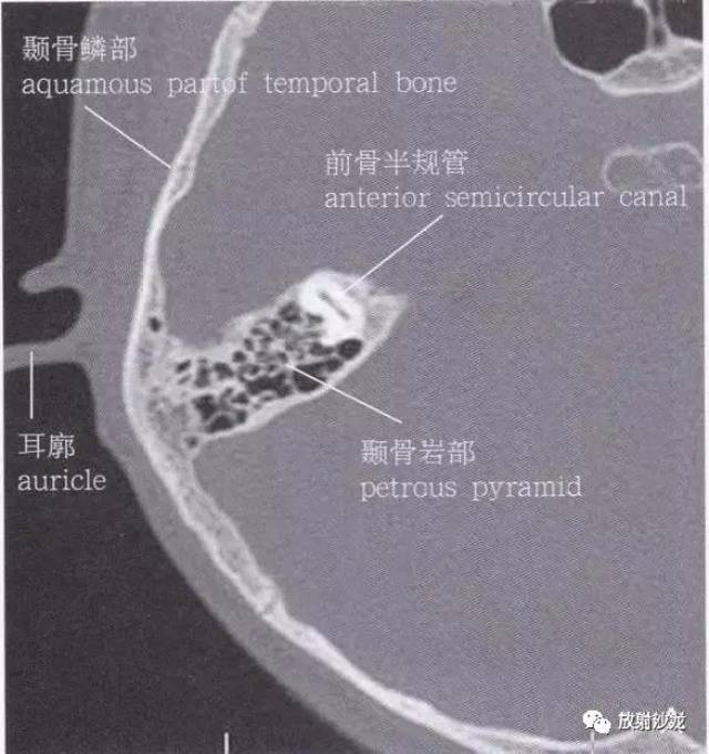 【解剖】颞骨大体解剖 轴位及冠状位ct断层图像