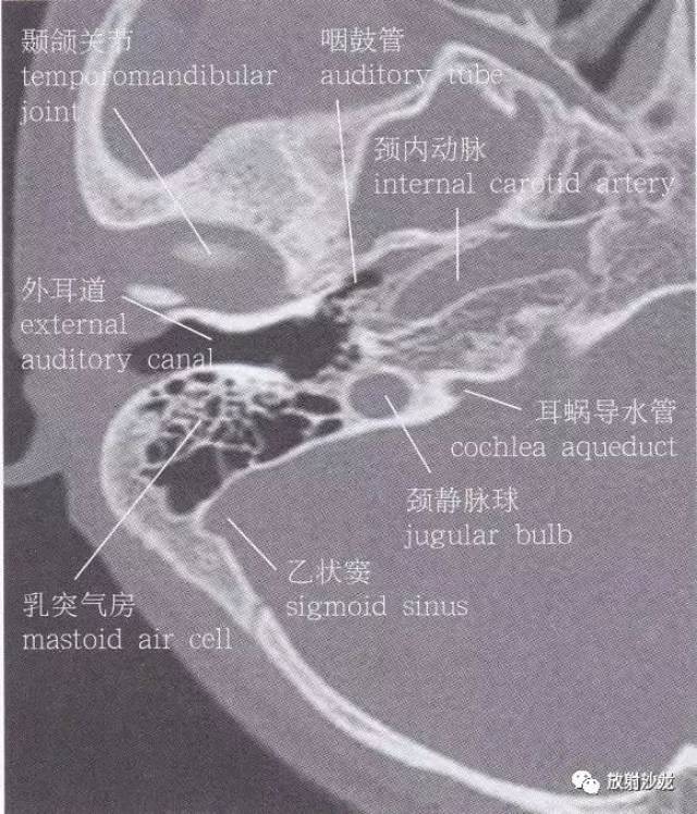 【解剖】颞骨大体解剖 轴位及冠状位ct断层图像