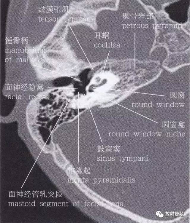 段),长3-4mm 第4段:水平段(鼓室段),长8-12mm 第5段:垂直段(乳突段)