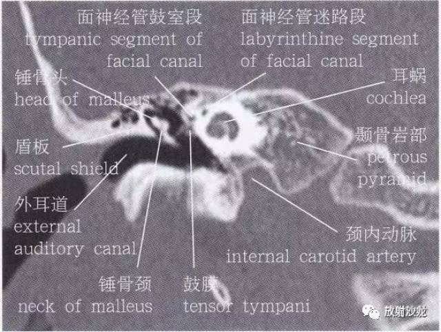 【解剖】颞骨大体解剖 轴位及冠状位ct断层图像