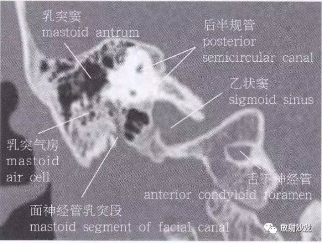 【解剖】颞骨大体解剖 轴位及冠状位ct断层图像