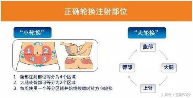 胰岛素注射产生脂肪增生,怎么办?