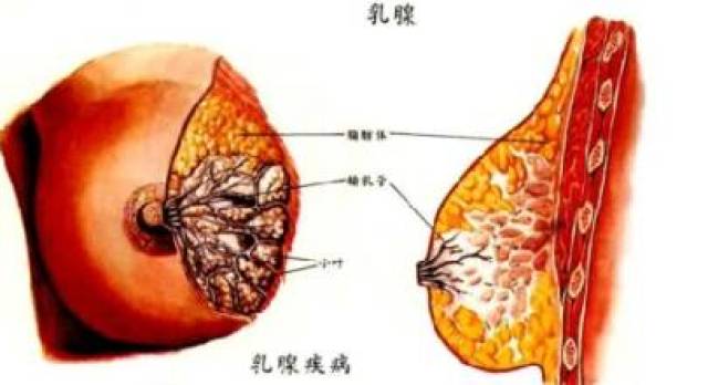 乳腺癌的4个早期症状,发现了别犹豫,马上去医院