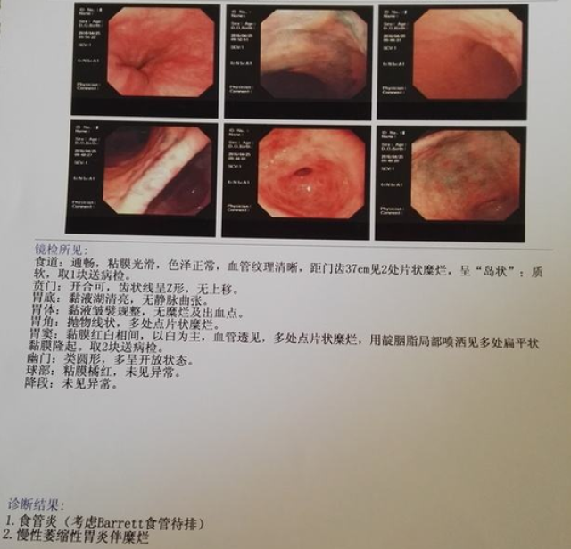 今年22岁,左下腹疼痛,差点就得了胃癌