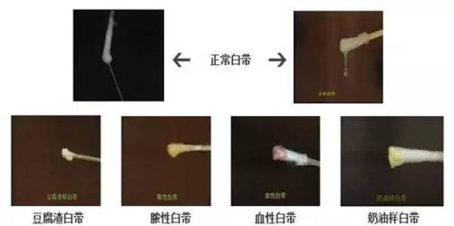 揭秘女性白带发黄的3大"祸首"!